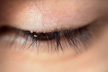 The Best Eye Hygiene Routine to Avoid Blepharitis